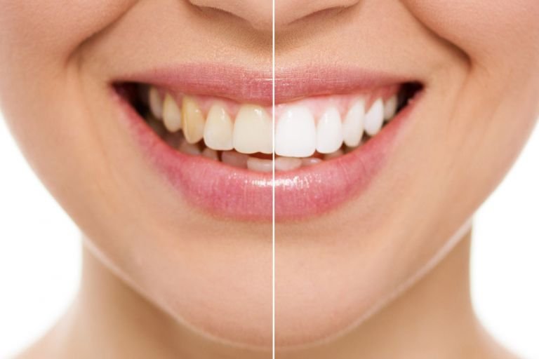 Sbiancamento Dentale
